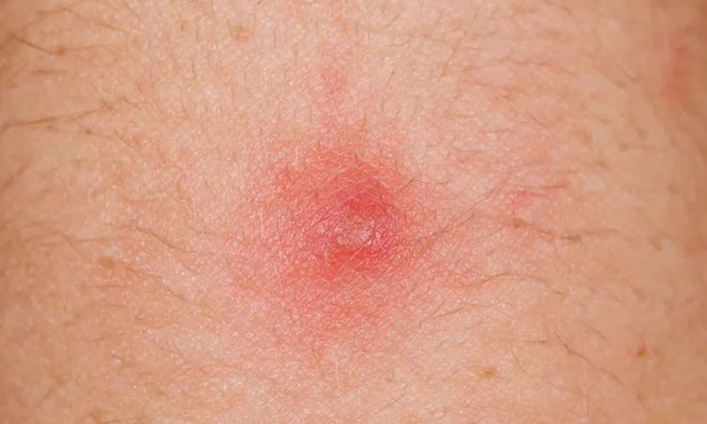 Popoda neden sivilce çıkar